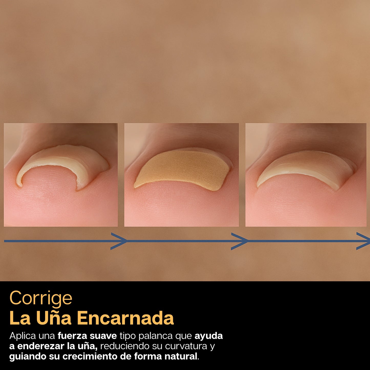 FitNail | Combo X2 Parches Correctores De Uñas Encarnadas