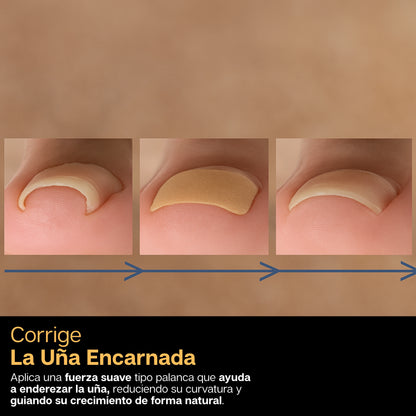 FitNail | Combo X2 Parches Correctores De Uñas Encarnadas