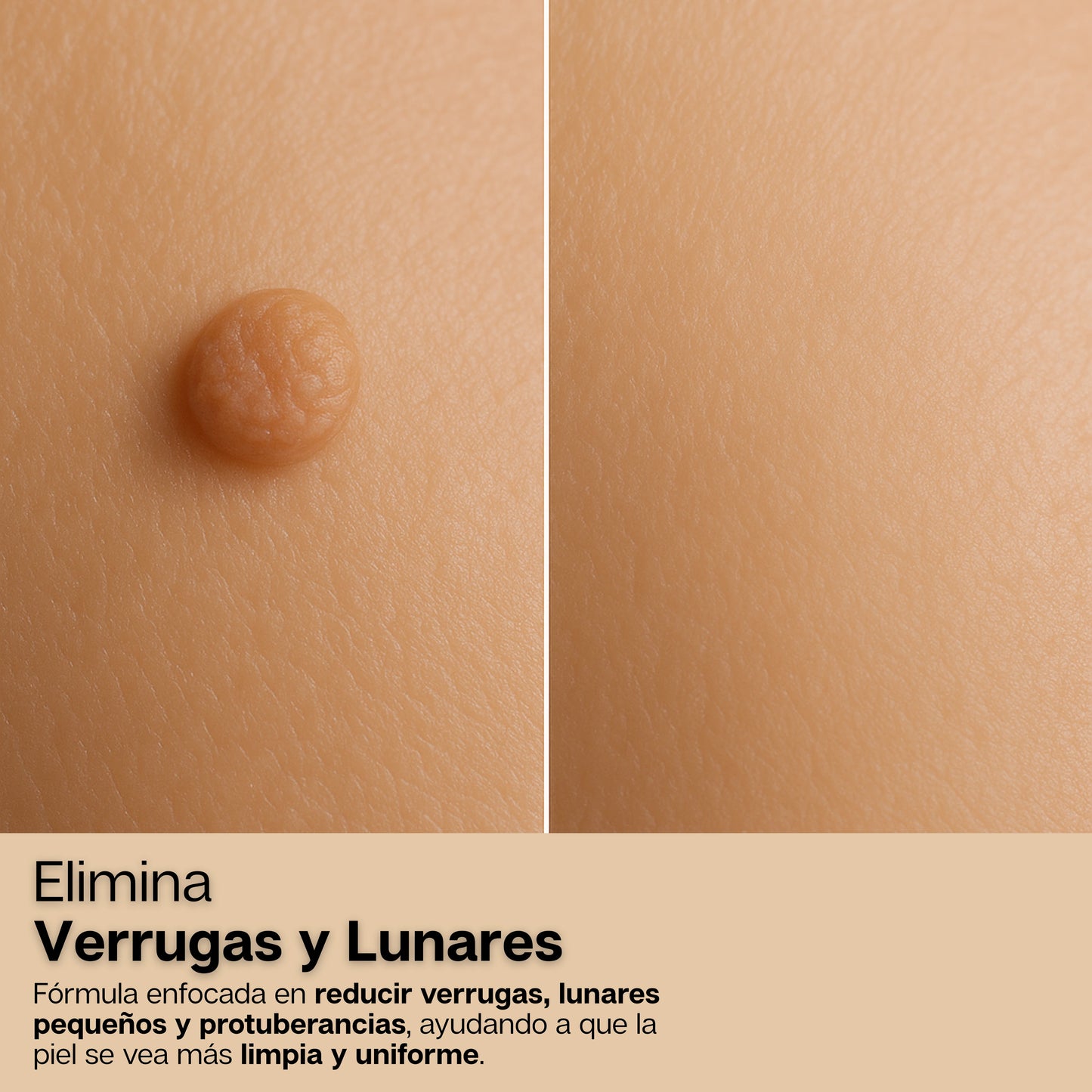 BeeDerm | Crema 100% Natural Removedora de Verrugas, Lunares y Cicatrices