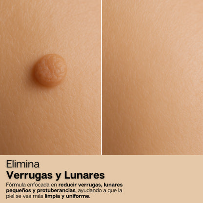 BeeDerm | Crema 100% Natural Removedora de Verrugas, Lunares y Cicatrices
