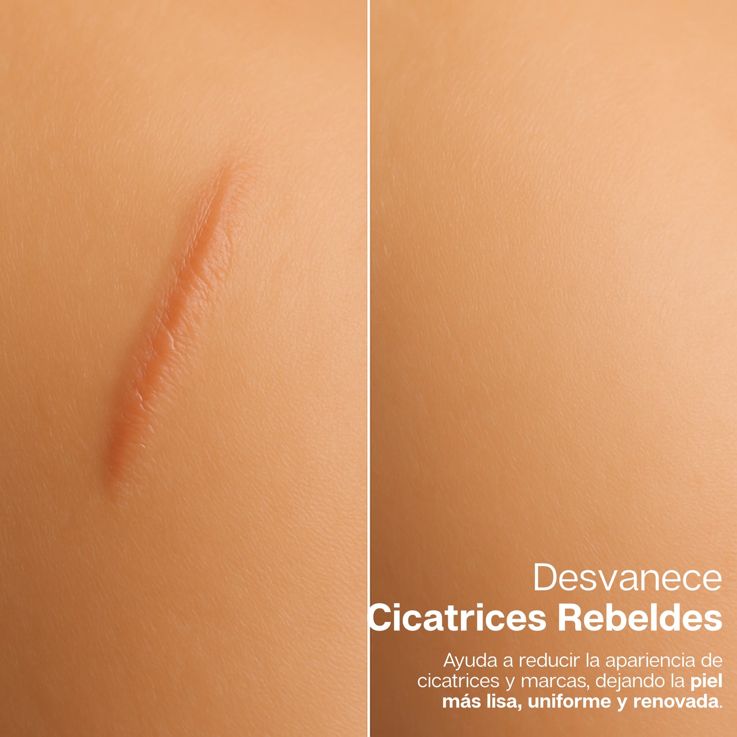 BeeDerm | Crema 100% Natural Removedora de Verrugas, Lunares y Cicatrices